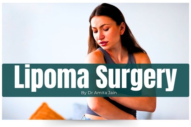 Dr Amita Jain is the best Lipoma Treatment and Surgeon in Delhi